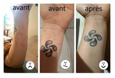 témoignage magnétiseur caroline auffret urticaire chronique  avant après