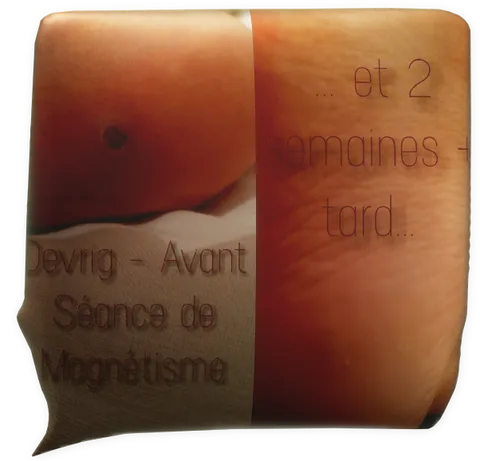Clic pour agrandir témoignage magnétiseur magnétisme verrue plantaire Dévrig Corbel Sylvie Marrec