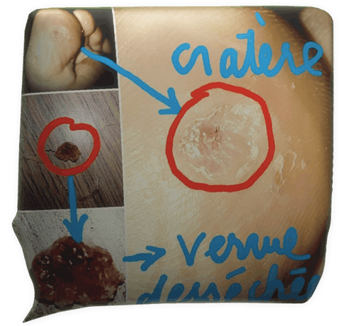 Clic pour agrandir témoignage magnétiseur magnétisme verrue plantaire Julie Dréo Riec sur Belon