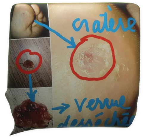 Clic pour agrandir témoignage magnétiseur magnétisme verrue plantaire Julie Dréo Riec sur Belon