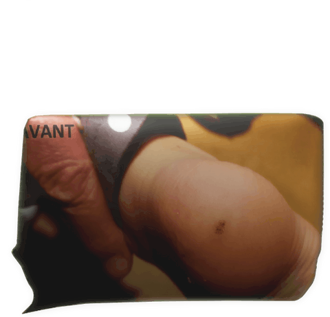 Clic pour agrandir verrue plantaire Enora Laëtitia Scuiller