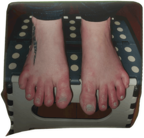 à la première séance (en attente du résultat final) dyshidrose (eczéma bulleux)