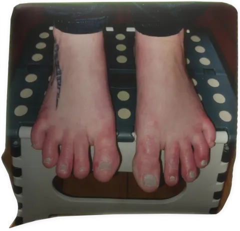 à la première séance (en attente du résultat final) dyshidrose (eczéma bulleux)