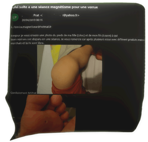 Clic pour agrandir témoignage magnétiseur Lilou Loann Prat verrue plantaire