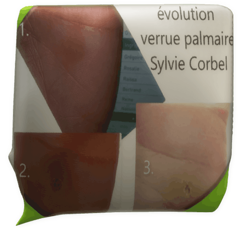 Clic pour agrandir témoignage magnétiseur Sylvie Corbel verrue palmaire Quimperlé