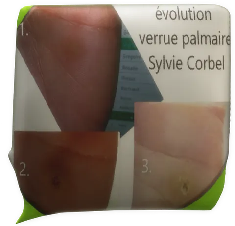 Clic pour agrandir témoignage magnétiseur Sylvie Corbel verrue palmaire Quimperlé